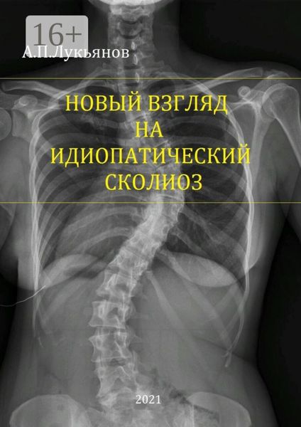 Обложка книги  «Новый взгляд на идиопатический сколиоз»