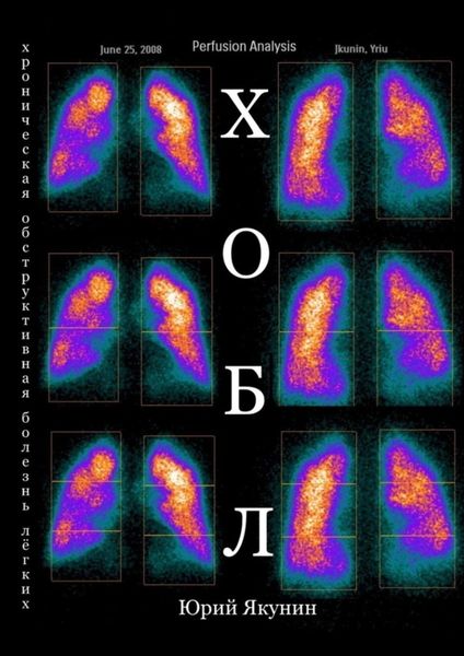 Обложка книги  «ХОБЛ. Хроническая обструктивная болезнь лёгких»
