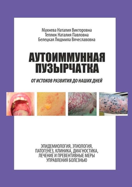 Обложка книги  «Аутоиммунная пузырчатка. От истоков развития до наших дней»